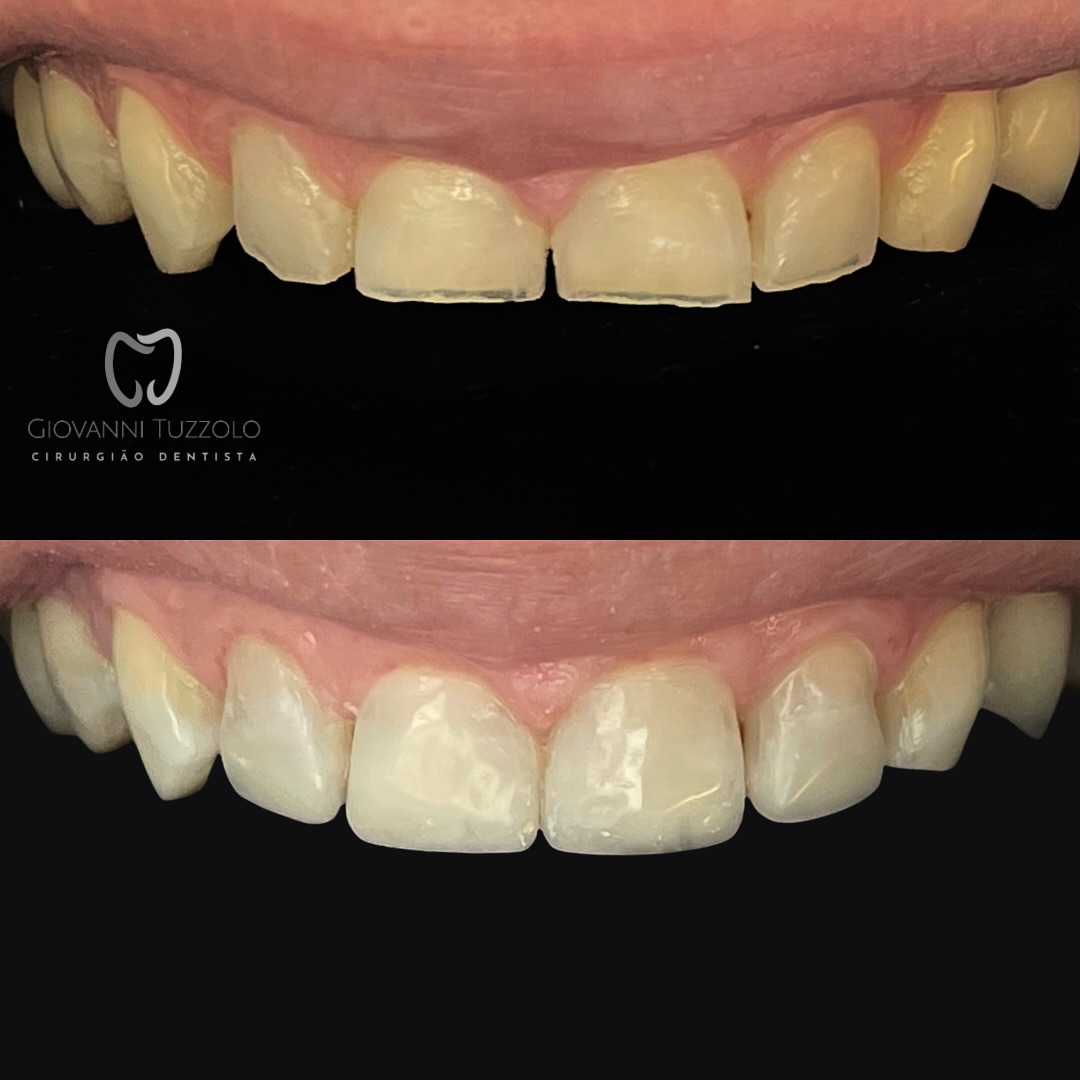 Lentes de Resina — antes e depois